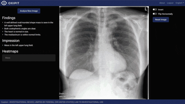 AI system recognizes normal chest x-rays
